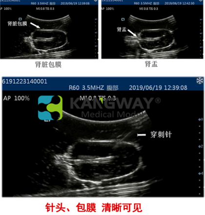 超聲引導下腎臟穿刺術訓練模塊